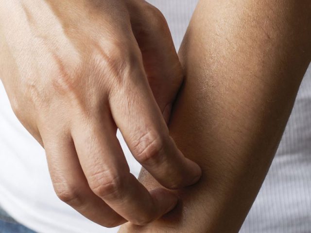 Top Tips for Treating Eczema